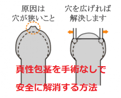 真性包茎を手術なしで安全に解消する方法