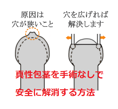 真性包茎を手術なしで安全に解消する方法